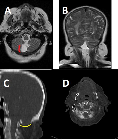 Mega Cisterna Magna (MCM) and Arachnoid Cysts (AC).